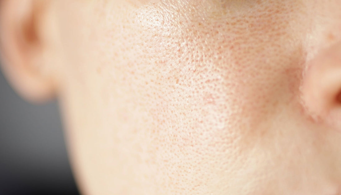 Early Stage Rosacea Symptoms: Things to Know